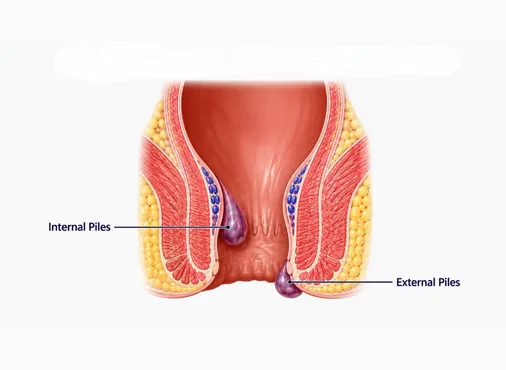 Piles (Haemorrhoids) consultation at Niraaya Hospital